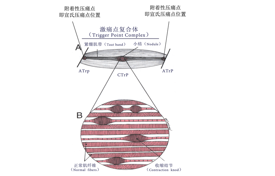 激痛点trigger point